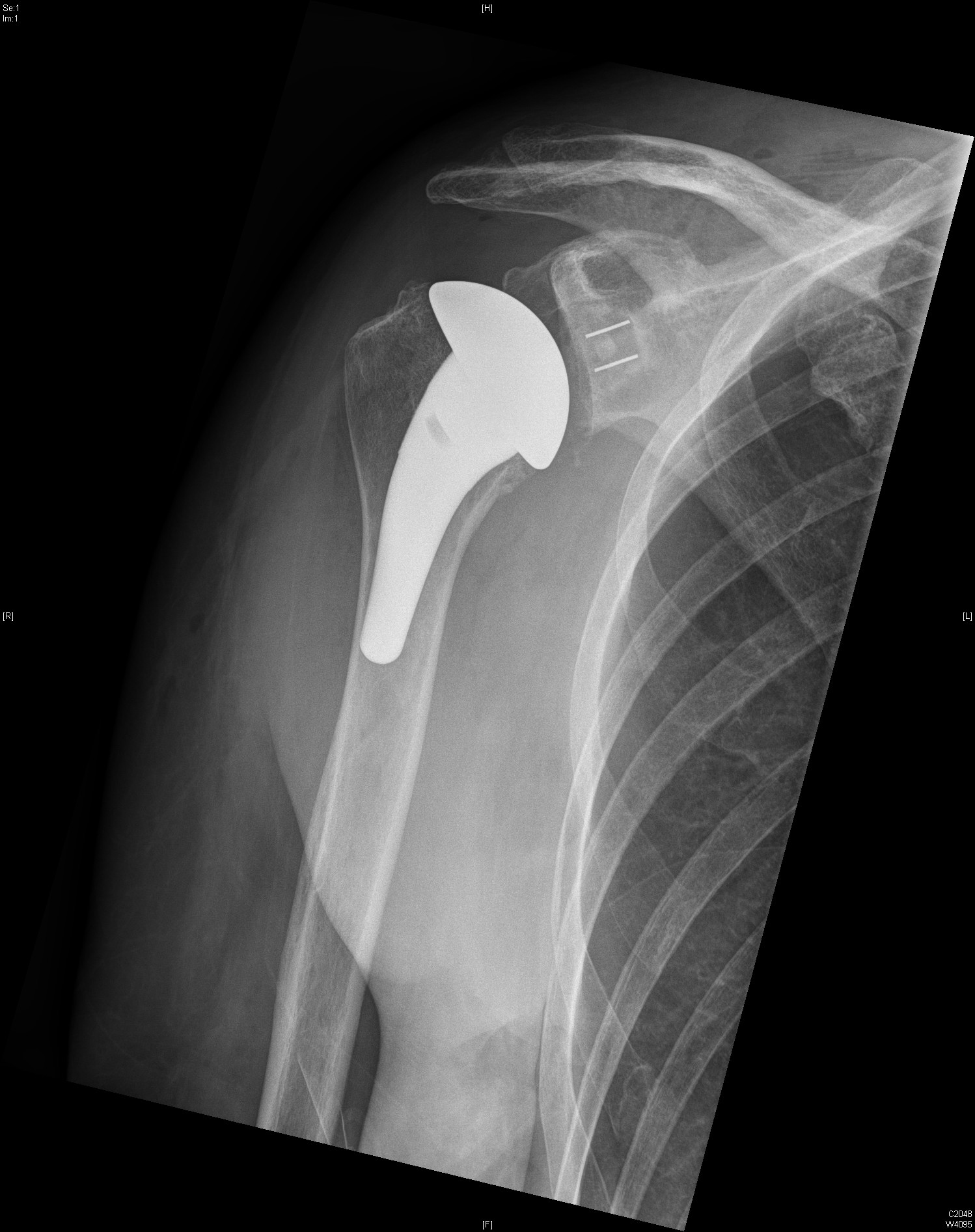 Röntgenbild einer Kalkschulter