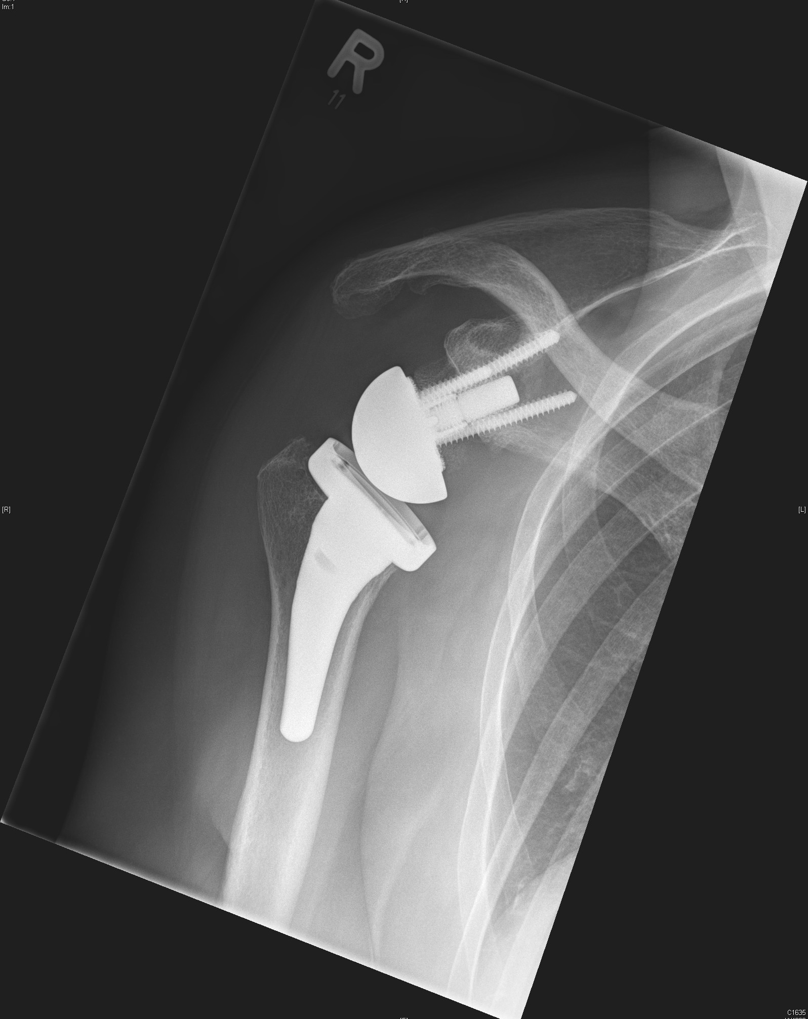 Röntgenbild einer Kalkschulter